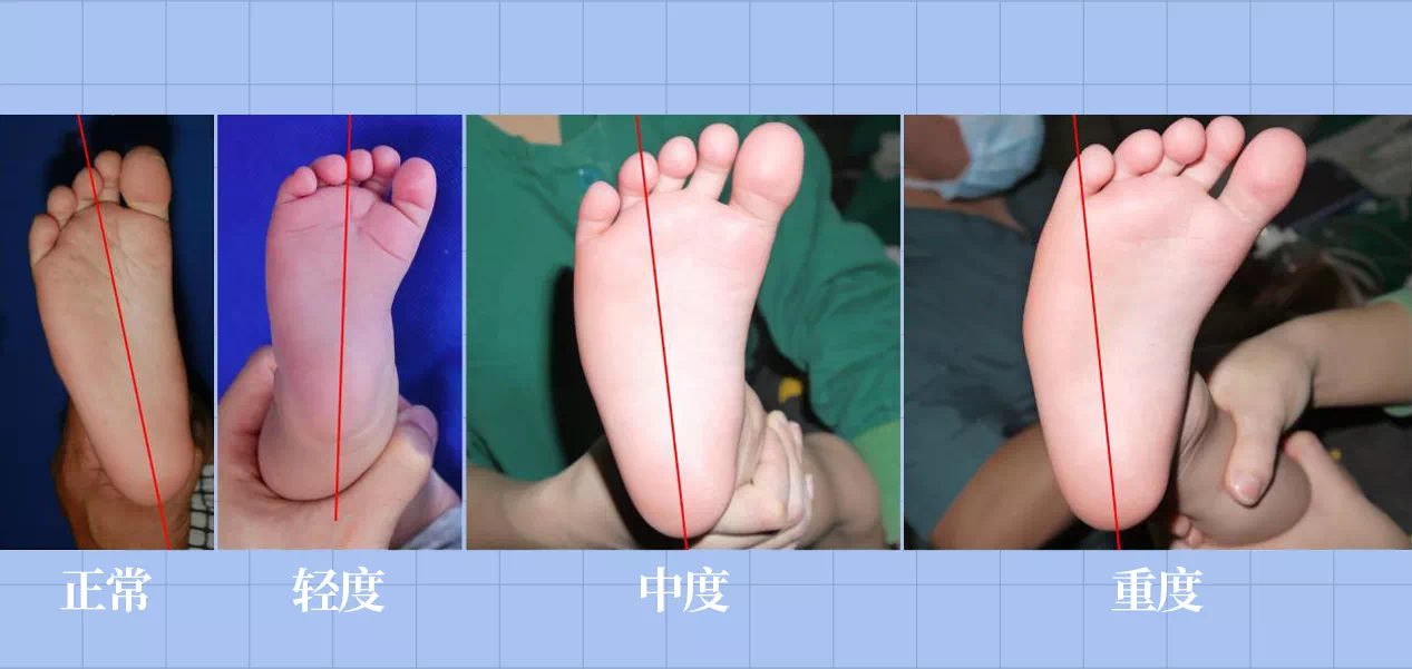 足底壓力分布計(jì)量